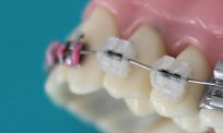 Beinahe unsichtbar, kosmetisch vorteilhaft und angenehm zu tragen, sind die zahnfarbenen Brackets in der modernen Zahnkorrektur eine sehr ästhetische Lösung.