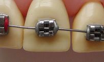 Die kleinsten Brackets der Welt kombinieren maximale Funktion mit minimaler Größe für eine effektive und zugleich ästhetische Behandlung.